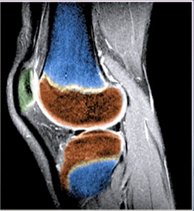 Sporeus - knee-MRI-1