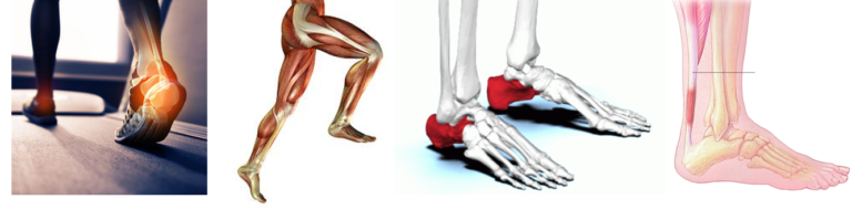 Aşil Tendinopatisi: Genel Nedenler, Tedavi, Antrenmana Dönüş