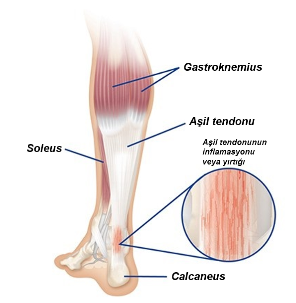 Aşil Tendinopatisi Genel Nedenler, Tedavi, Antrenman Dönüş - Görsel