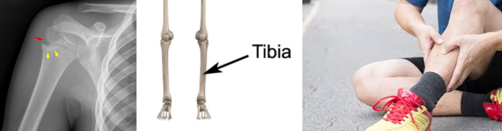 Stres Kırıkları - Genel Nedenler, Tedavi ve Antrenmanlara Dönüş - Öne Çıkan Görsel