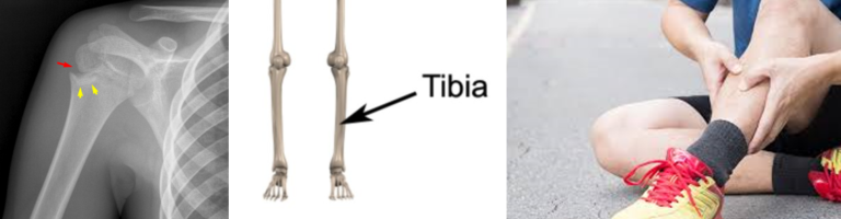 Stres Kırıkları: Genel Nedenler, Tedavi ve Antrenmanlara Dönüş
