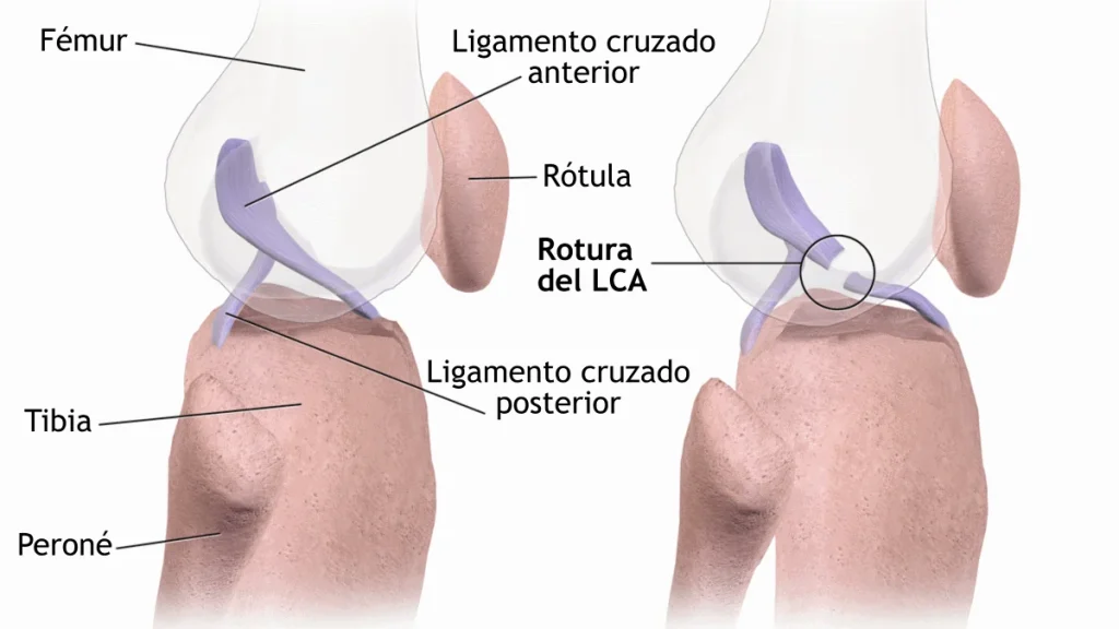 ACL Injury Biomechanics — Why It Tears and How to Protect It