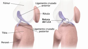 ACL Injury Biomechanics — Why It Tears and How to Protect It