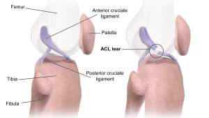 Overuse Bone Injuries — Stress Fractures and How They Develop
