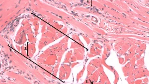 Hamstring Tear Biomechanics: Why the Most Common Injury Keeps Happening