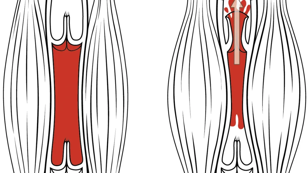 Hamstring Yaralanmaları: Neden Tekrarlar?