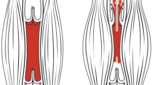 Hamstring Yaralanmaları: Neden Tekrarlar?